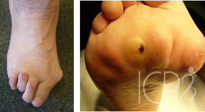 ICPR la pathologie de l'avant-pied rumathoïde