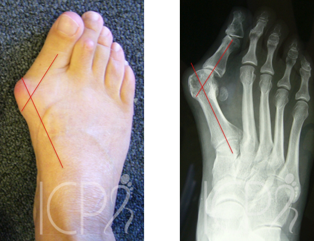 hallux vaglus