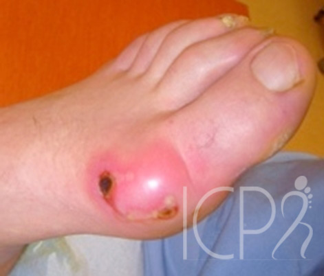 hallux vaglus infection orteil