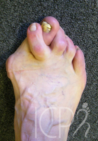 hallux vaglus griffes d’orteil