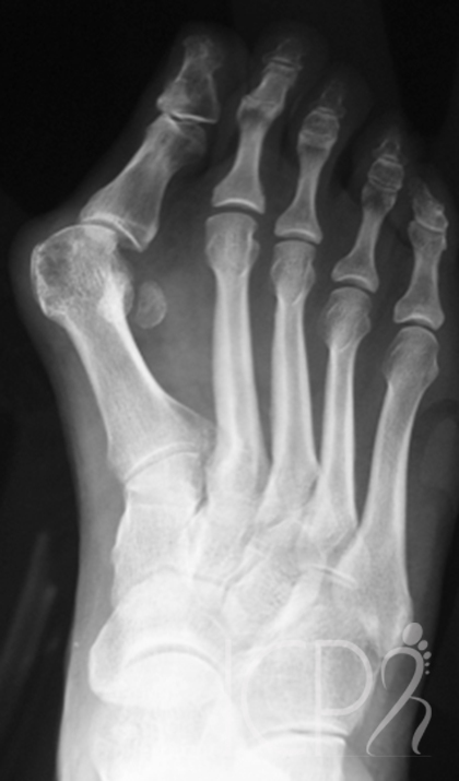 Radio hallux vaglus