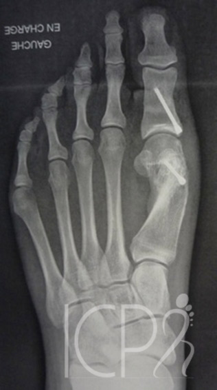 hallux vaglus double ostéotomie 