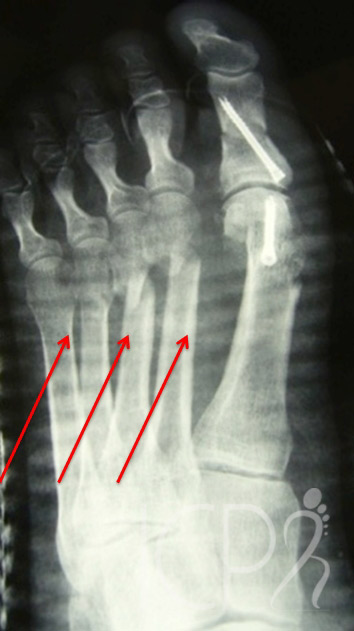 hallux vaglus chirurgie percutanée