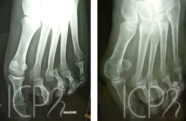 Anomalie osseuse de l'avant-pied 