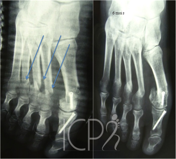 Radio métatarsalgies chirurgie