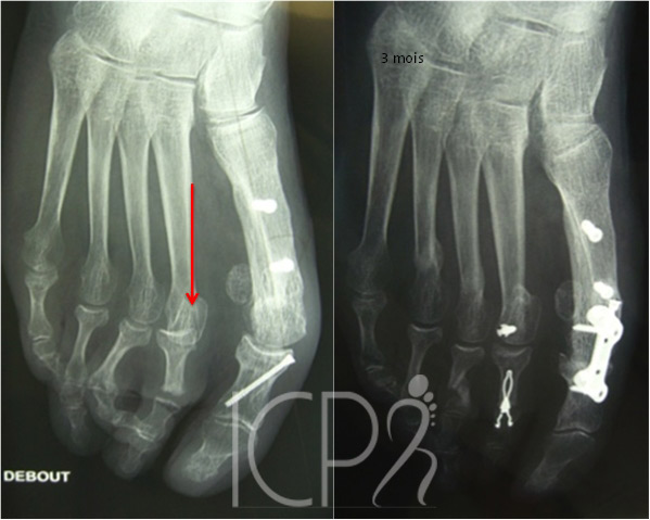 Radio métatarsalgies après chirurgie