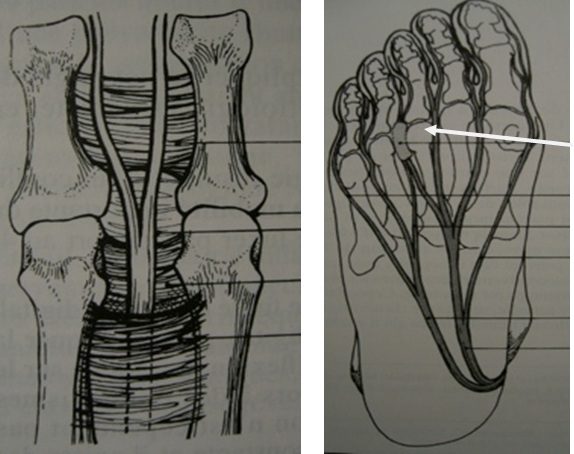 ICPR pathologie Névrome de Morton