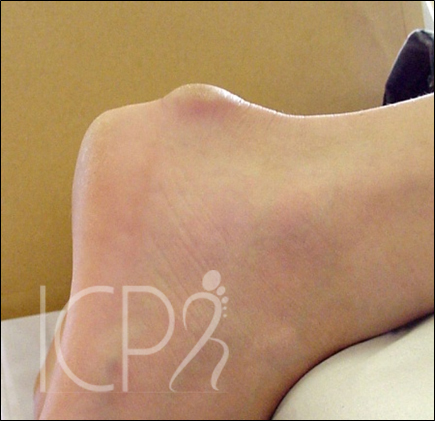 ICPR pathologie Tendinopathies d'Achille