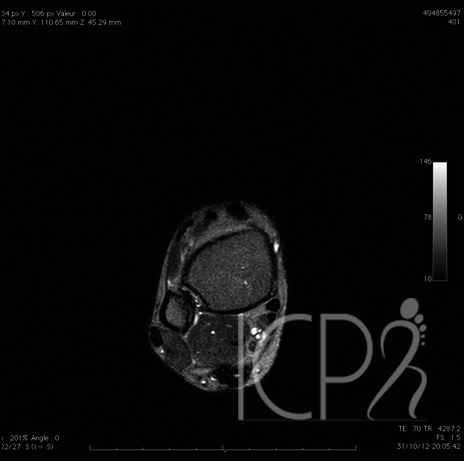 ICPR pathologie Tendinopathies d'Achille